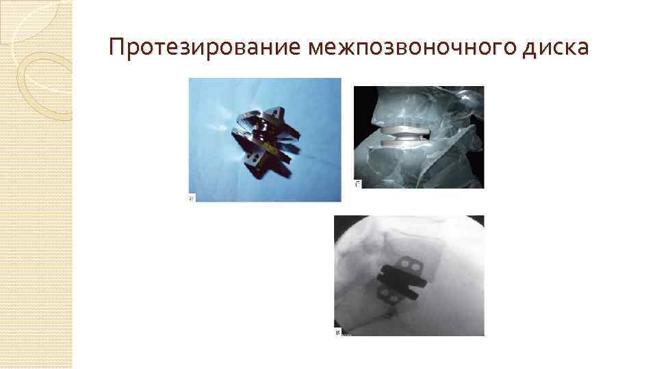 Протезирование межпозвоночного диска 