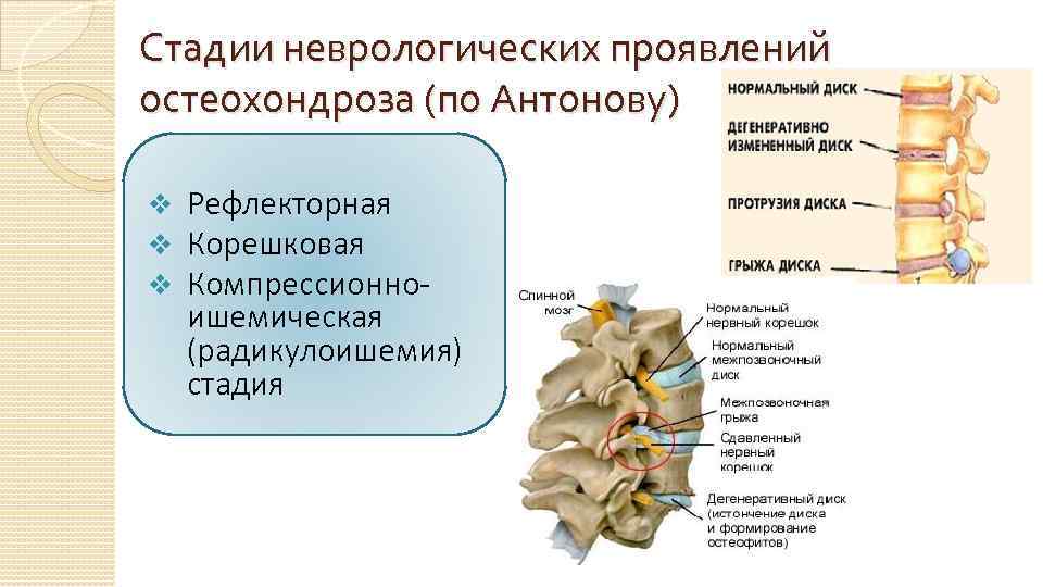 Синдромы поясничного отдела позвоночника. Корешковый синдром шейного отдела с4. Корешковый синдром поясничного отдела позвоночника. Корешковые симптомы остеохондроза грудного отдела. Симптомы поражения Корешков шейного отдела.