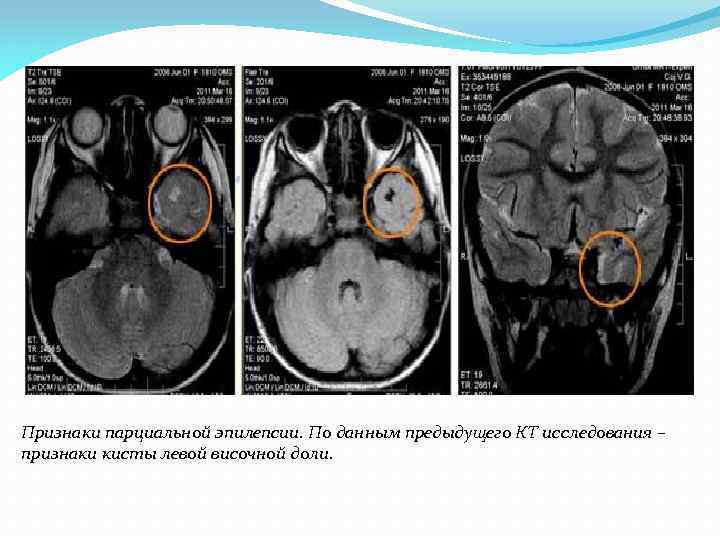 Признаки парциальной эпилепсии. По данным предыдущего КТ исследования – признаки кисты левой височной доли.