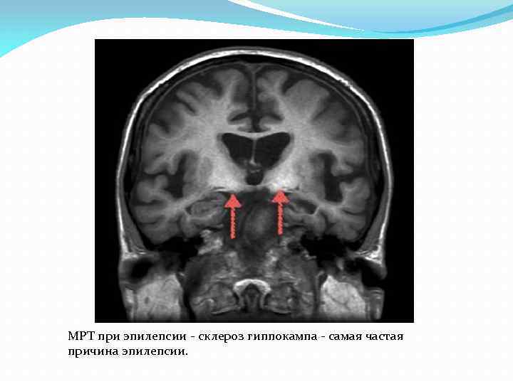 МРТ при эпилепсии - склероз гиппокампа - самая частая причина эпилепсии. 