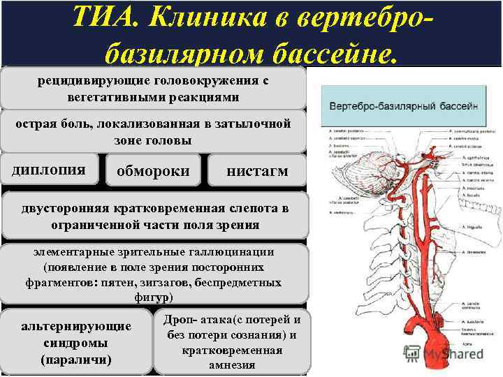 ТИА. Клиника в вертебробазилярном бассейне. рецидивирующие головокружения с вегетативными реакциями острая боль, локализованная в