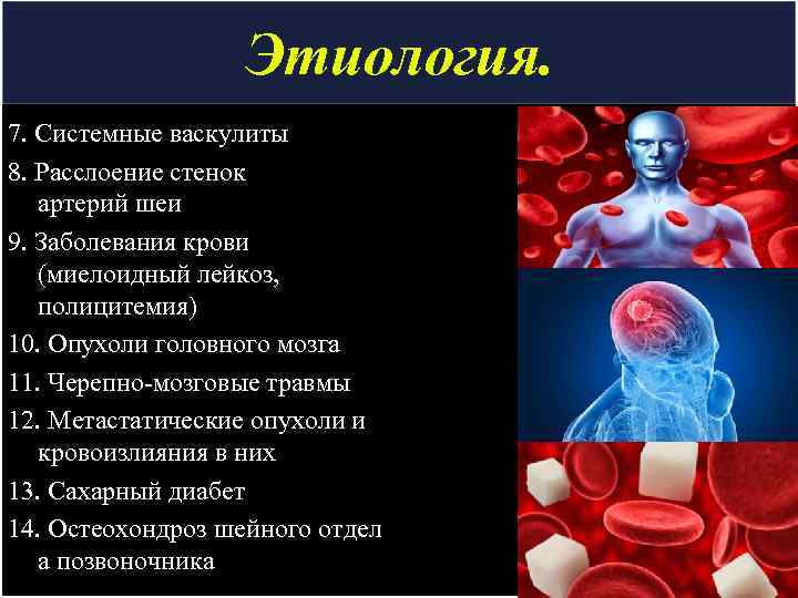 Этиология. 7. Системные васкулиты 8. Расслоение стенок артерий шеи 9. Заболевания крови (миелоидный лейкоз,