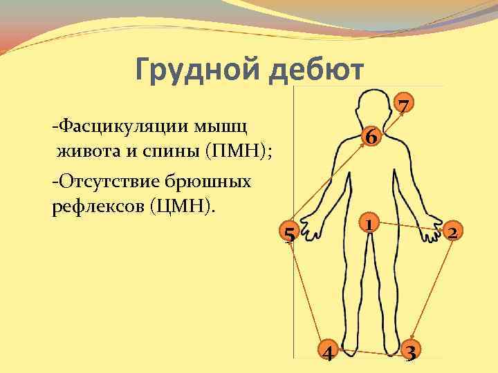 Грудной дебют -Фасцикуляции мышц живота и спины (ПМН); -Отсутствие брюшных рефлексов (ЦМН). 7 6