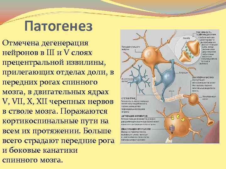 Патогенез Отмечена дегенерация нейронов в III и V слоях прецентральной извилины, прилегающих отделах доли,