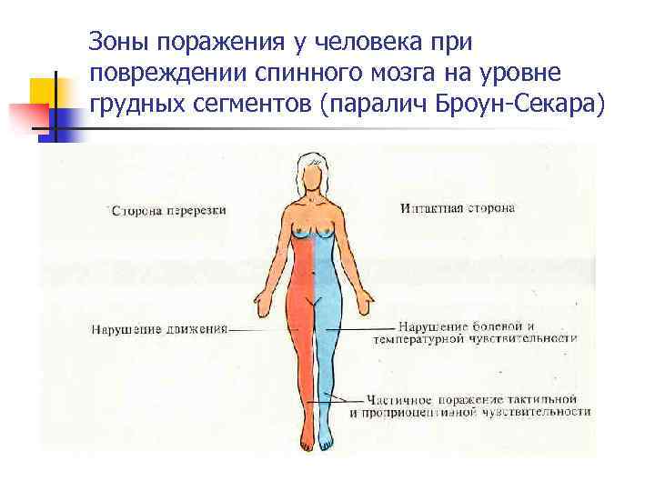 Зоны поражения у человека при повреждении спинного мозга на уровне грудных сегментов (паралич Броун-Секара)