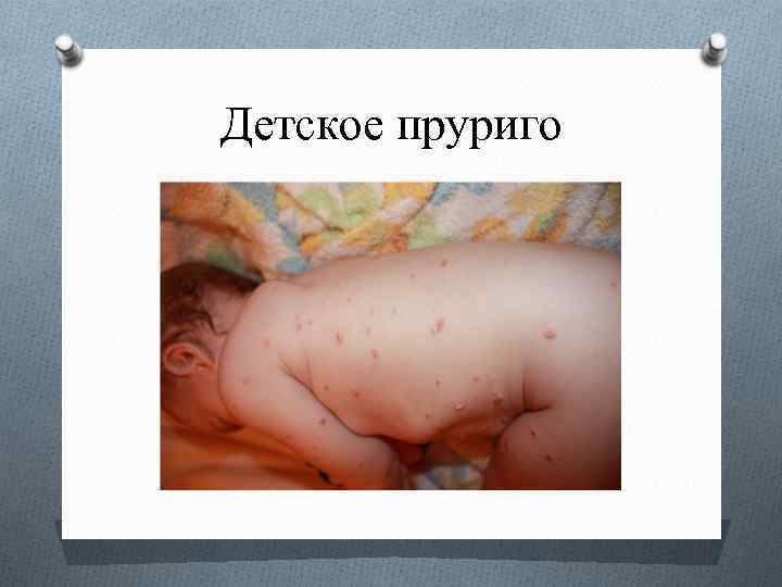 Детское пруриго 