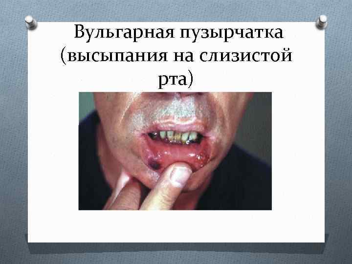  Вульгарная пузырчатка (высыпания на слизистой рта) 