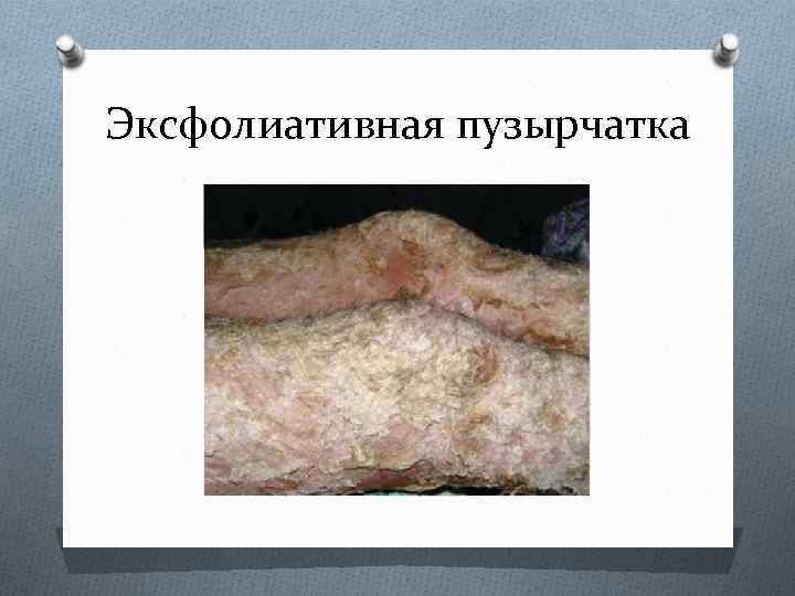 Эксфолиативная пузырчатка 