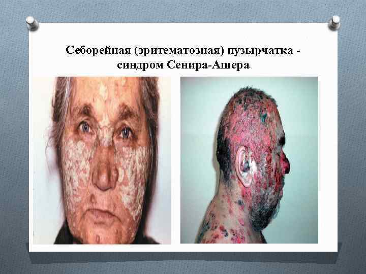 Себорейная (эритематозная) пузырчатка - синдром Сенира-Ашера 