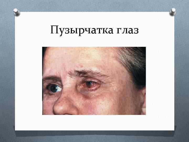 Пузырчатка глаз 