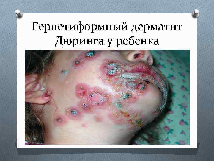 Герпетиформный дерматит Дюринга у ребенка 