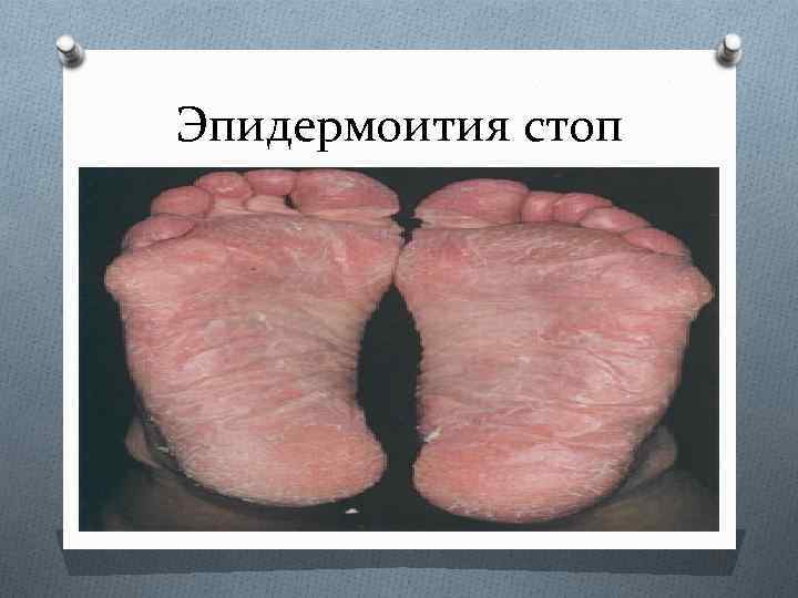 Эпидермоития стоп 