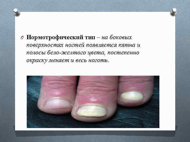 O Нормотрофический тип – на боковых поверхностях ногтей появляется пятна и полосы бело-желтого цвета,