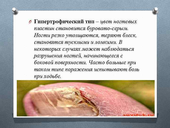 O Гипертрофический тип – цвет ногтевых пластин становится буровато-серым. Ногти резко утолщаются, теряют блеск,