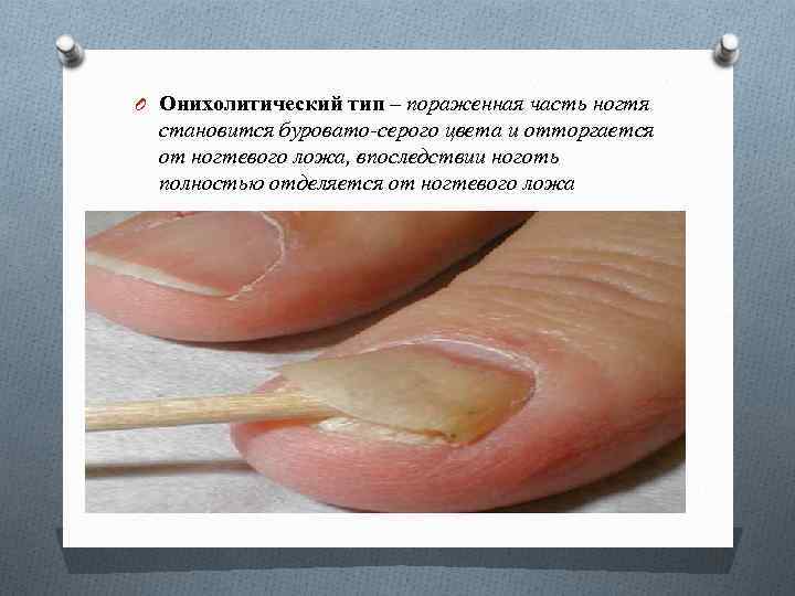 O Онихолитический тип – пораженная часть ногтя становится буровато-серого цвета и отторгается от ногтевого