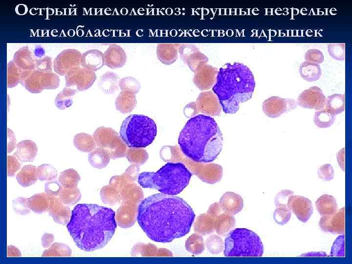 Острый миелолейкоз: крупные незрелые миелобласты с множеством ядрышек 
