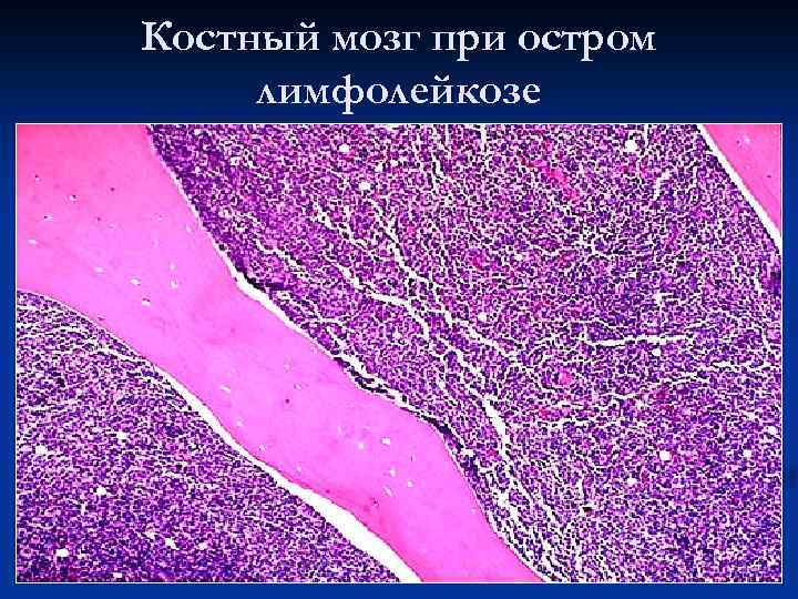 Костный мозг жидкость. Хронический лимфолейкоз гистология. Хронический миелолейкоз гистология. Острый лимфобластный лейкоз гистология. Хронический миелолейкоз костный мозг макропрепарат.
