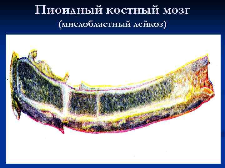 Пиоидный костный мозг (миелобластный лейкоз) 