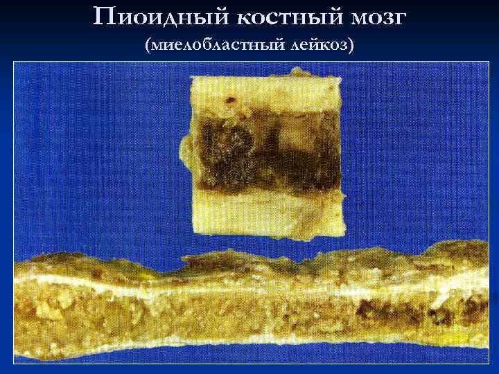 Пиоидный костный мозг (миелобластный лейкоз) 