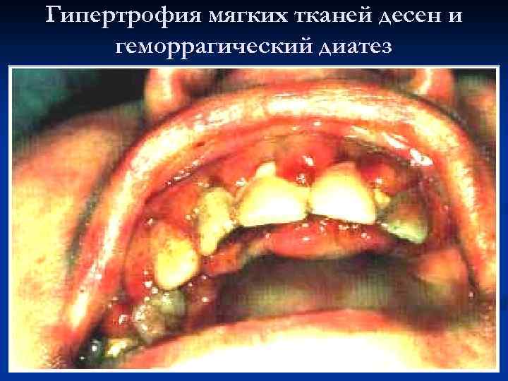 Гипертрофия мягких тканей десен и геморрагический диатез 