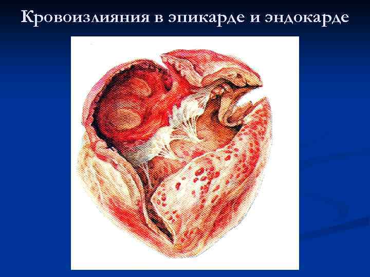 Кровоизлияния в эпикарде и эндокарде 