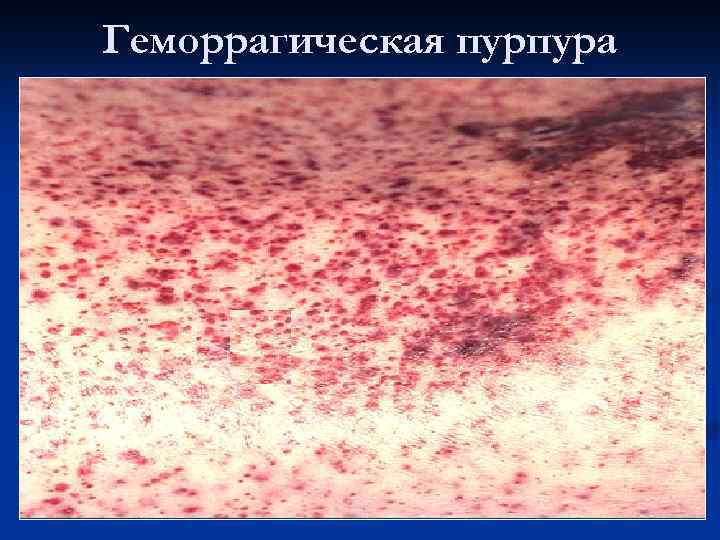 Геморрагическая пурпура 
