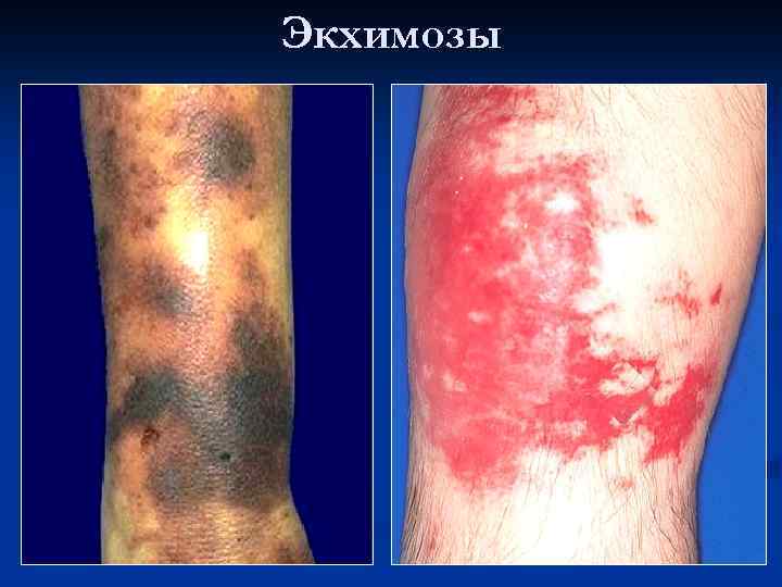 Экхимозы 