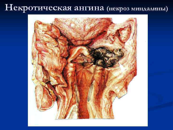 Некротическая ангина (некроз миндалины) 
