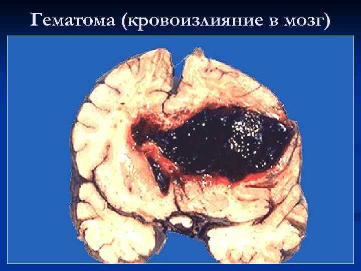 Гематома (кровоизлияние в мозг) 