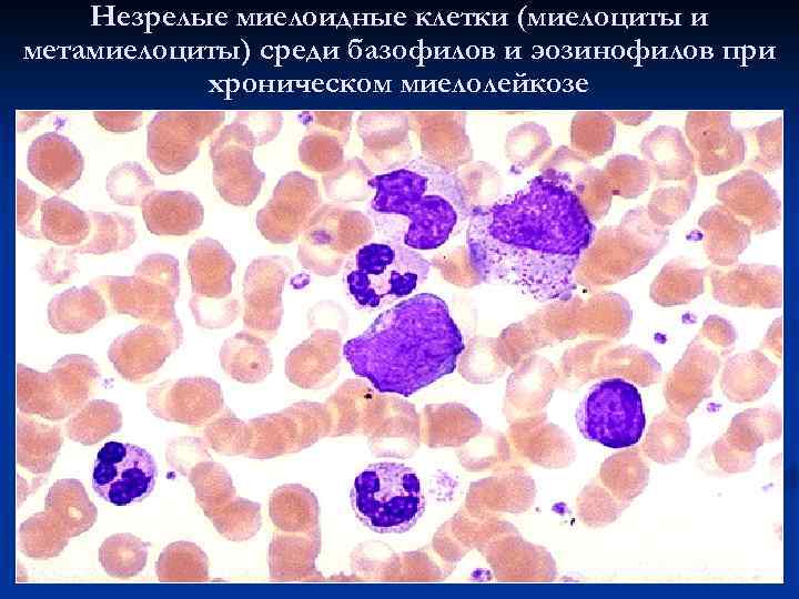 Миелоциты в костном мозге. Миелоциты и метамиелоциты. Незрелые миелоидные клетки. Незрелые клетки миелоидного ряда. Миелоциты гистология.