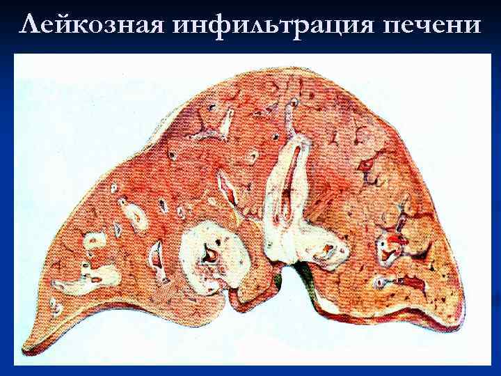 Лейкозная инфильтрация печени 