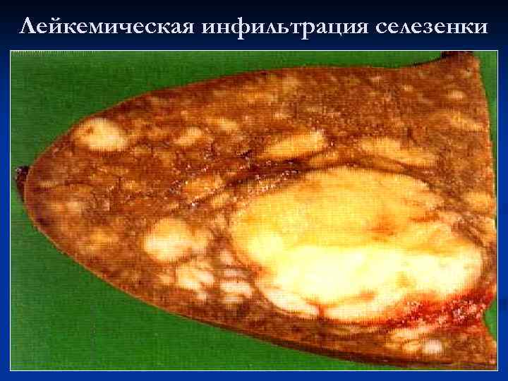 Лейкемическая инфильтрация селезенки 
