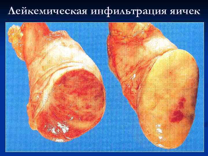 Лейкемическая инфильтрация яичек 