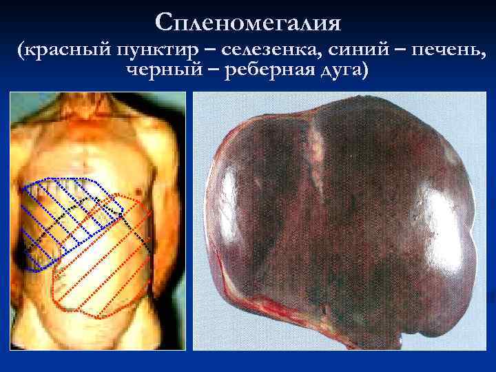 Спленомегалия (красный пунктир – селезенка, синий – печень, черный – реберная дуга) 