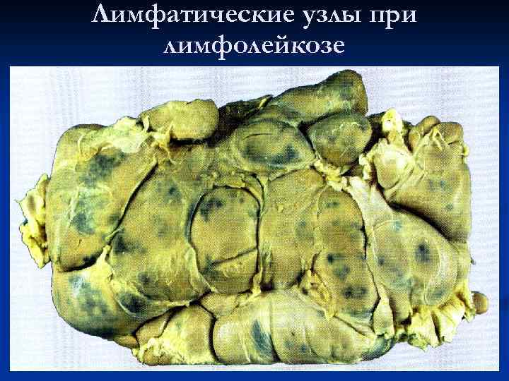 Лимфатические узлы при лимфолейкозе 