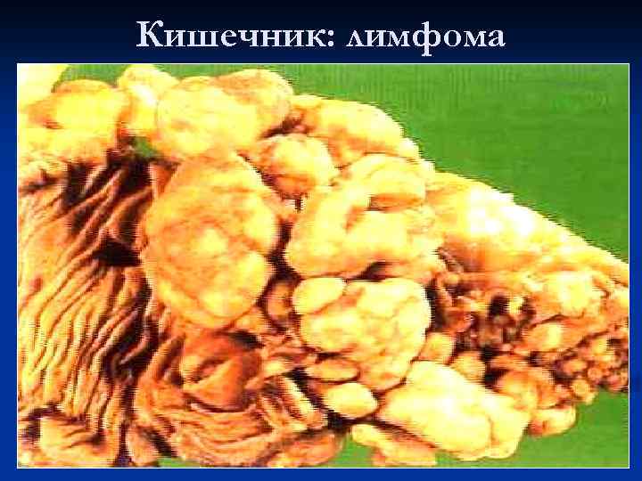 Кишечник: лимфома 