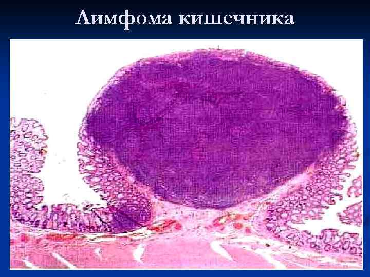 Лимфома кишечника 