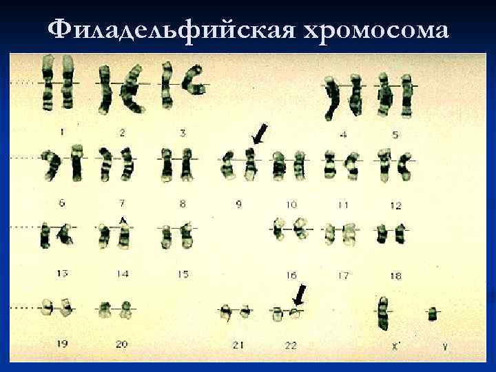 Филадельфийская хромосома 