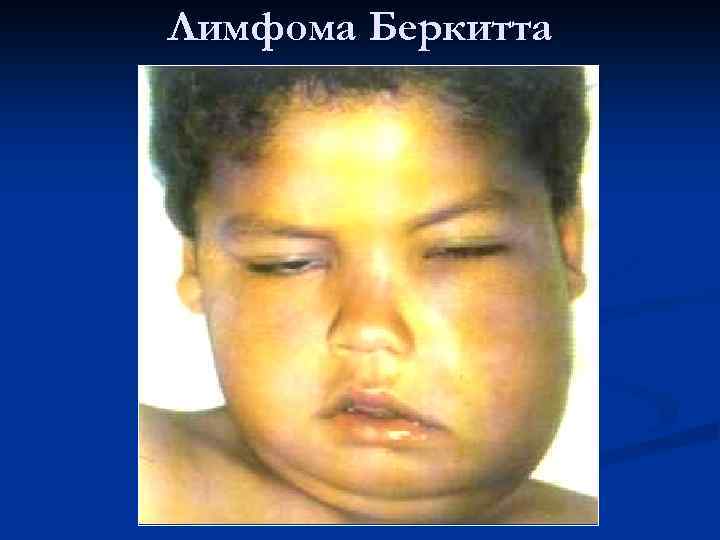 Лимфома Беркитта 