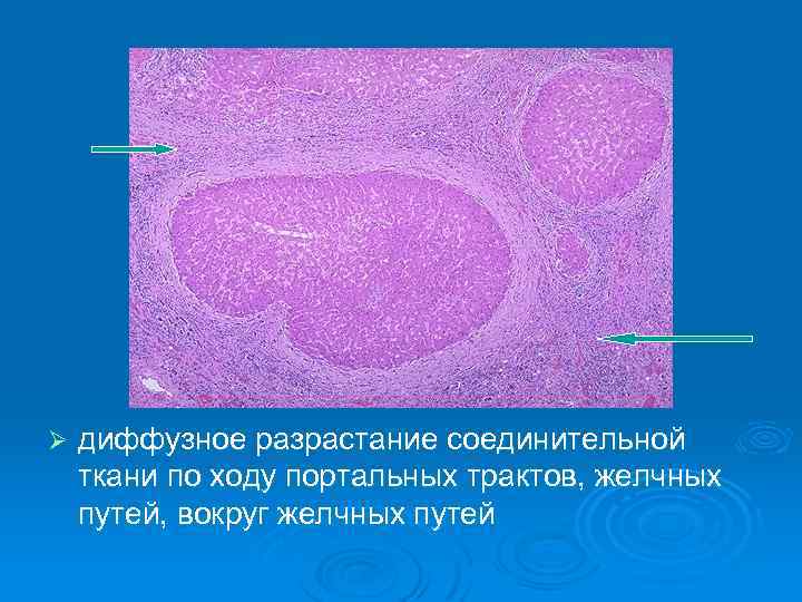Ø диффузное разрастание соединительной ткани по ходу портальных трактов, желчных путей, вокруг желчных путей