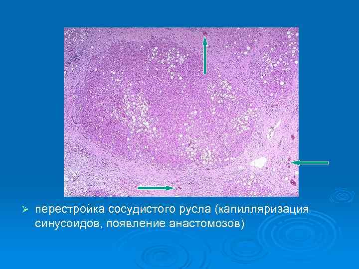 Ø перестройка сосудистого русла (капилляризация синусоидов, появление анастомозов) 
