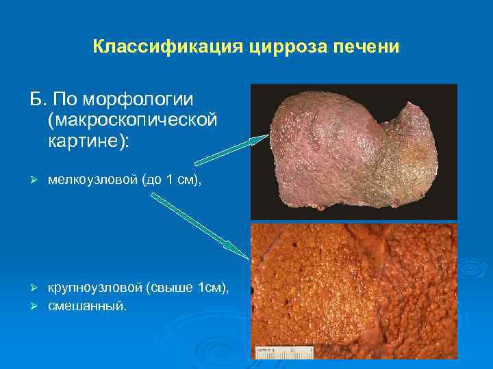 Классификация цирроза печени Б. По морфологии (макроскопической картине): Ø мелкоузловой (до 1 см), крупноузловой