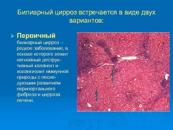 Билиарный цирроз встречается в виде двух вариантов: Ø Первичный билиарный цирроз редкое заболевание, в