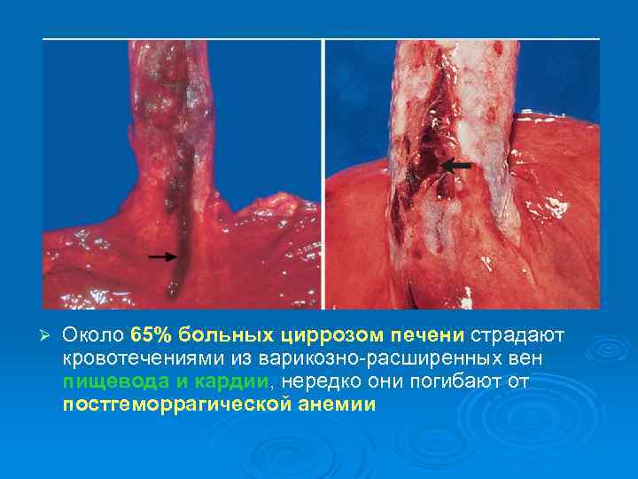 Ø Около 65% больных циррозом печени страдают кровотечениями из варикозно-расширенных вен пищевода и кардии,