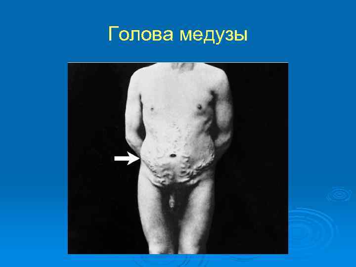 Голова медузы 