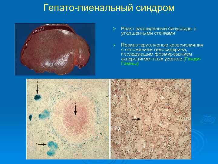 Гепато-лиенальный синдром Ø Резко расширенные синусоиды с утолщенными стенками Ø Периартериолярные кровоизлияния с отложением
