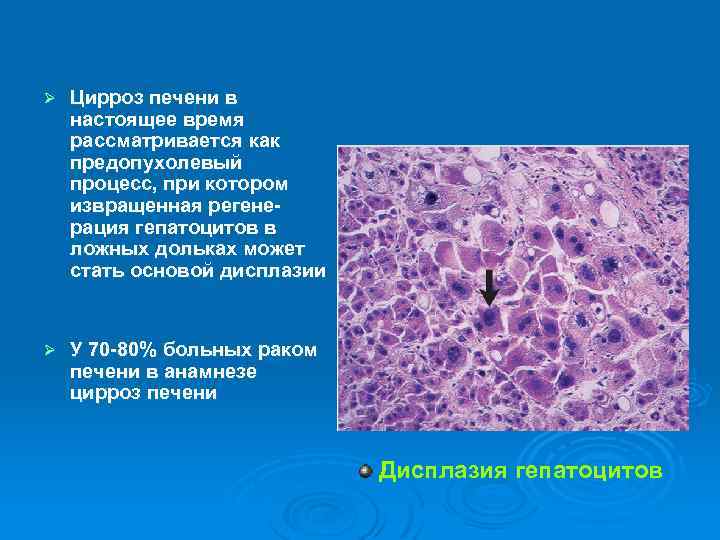 Сосудистый рисунок печени обеднен что это означает при гепатозе печени