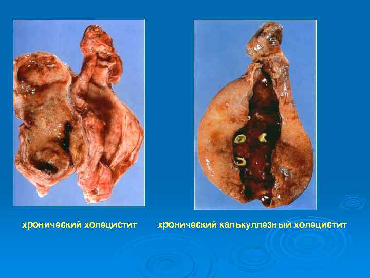 хронический холецистит хронический калькуллезный холецистит 