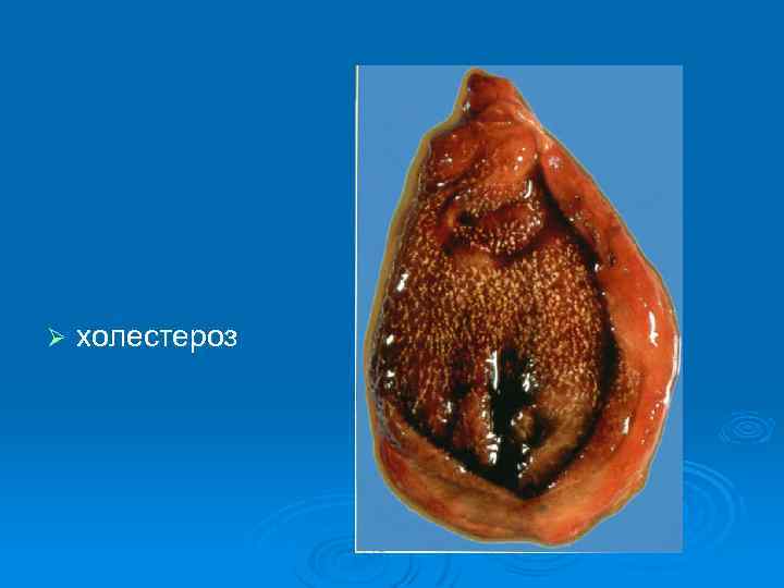 Ø холестероз 