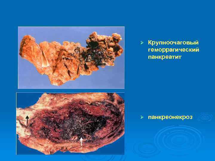 Цирроз печени на фоне гепатита с